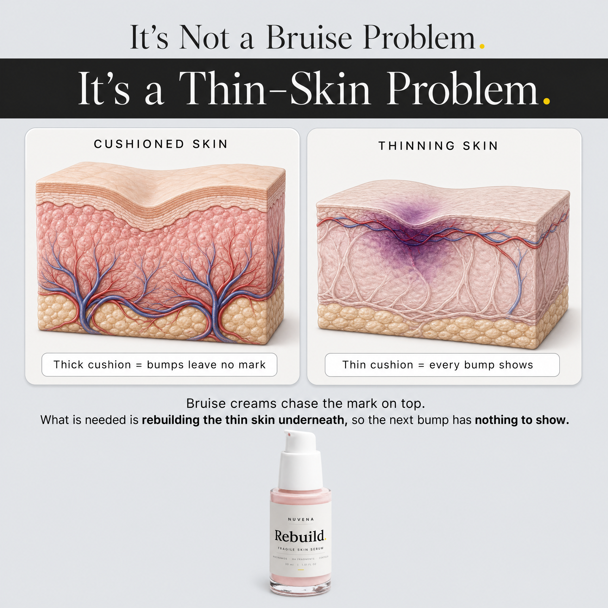 It's not a bruise problem, it's a thin-skin problem — skin cross-section comparison